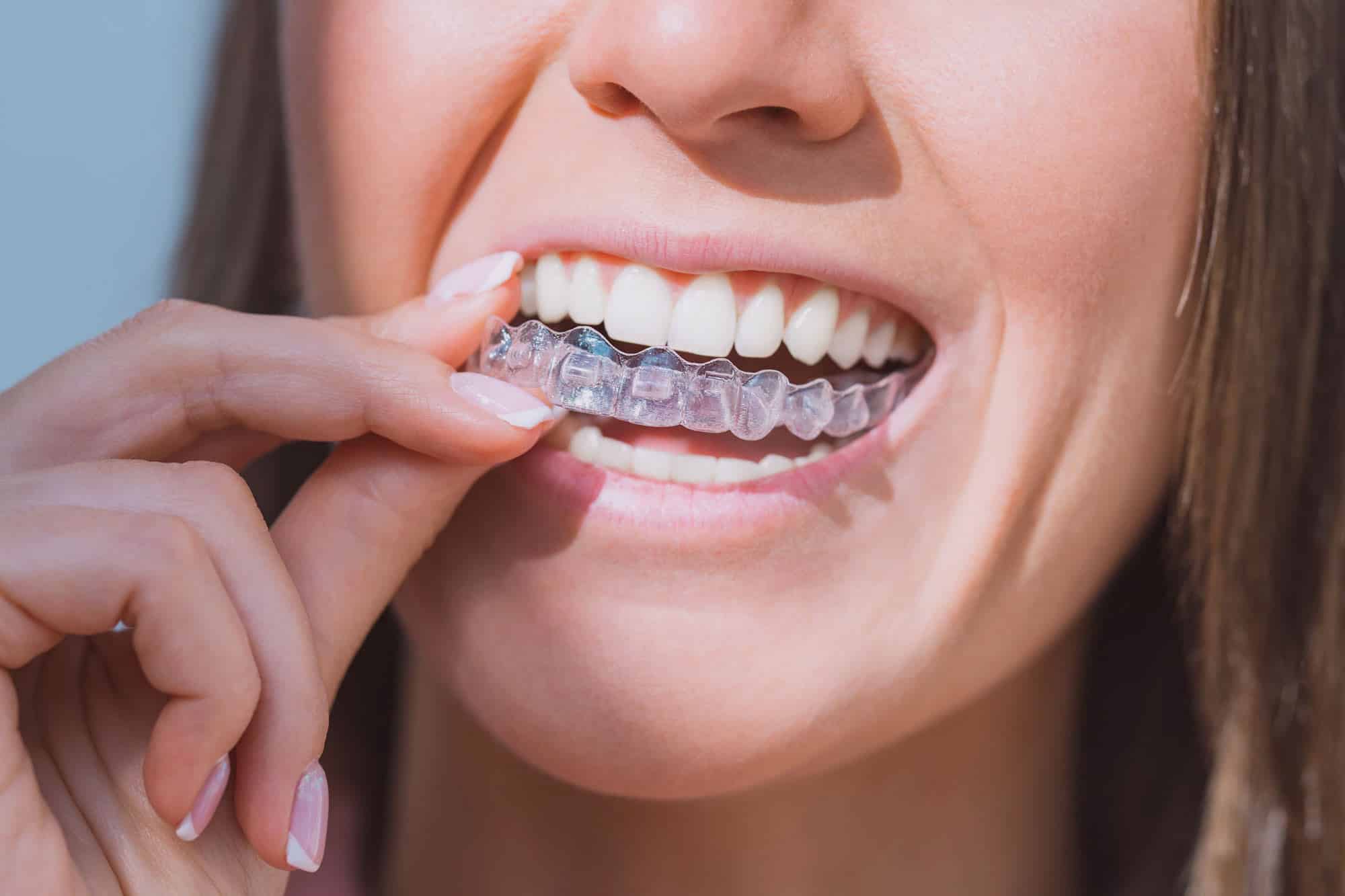 Say Goodbye to Braces - How Suresmile Aligners Give You a Straighter Smile