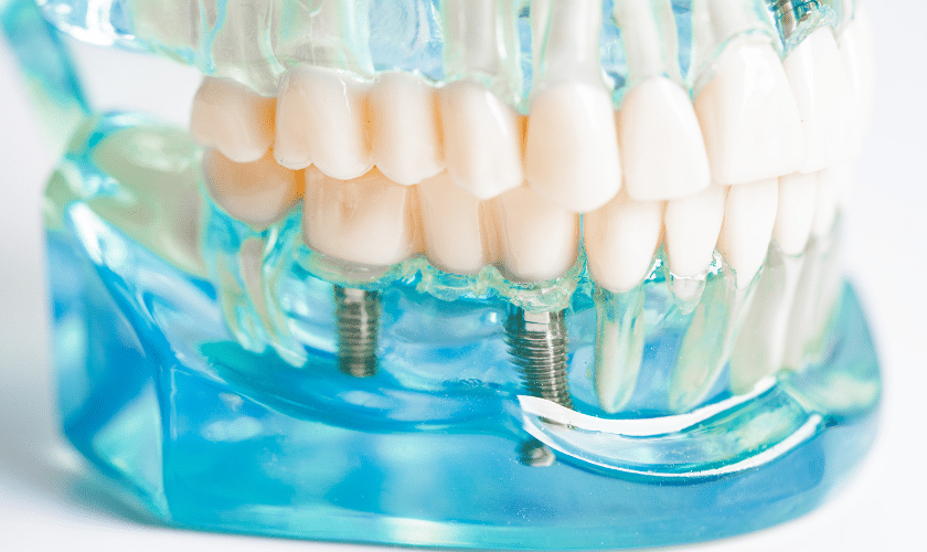 Exploring All-on-X Dental Implants vs Traditional Ones