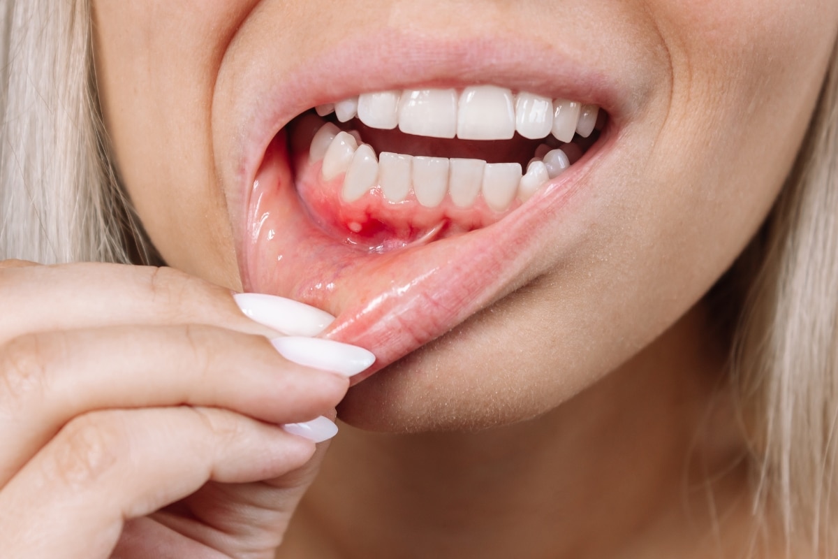Gum Disease Treatment Nederland