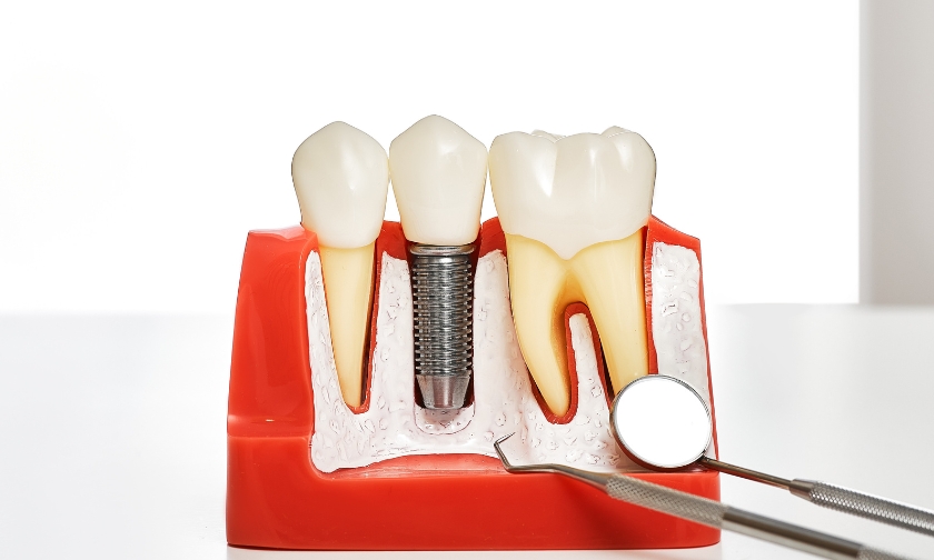 prevent jaw bone loss with dental implants