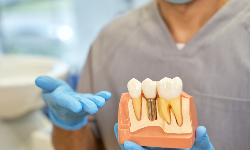 understanding the eligibility of dental implants