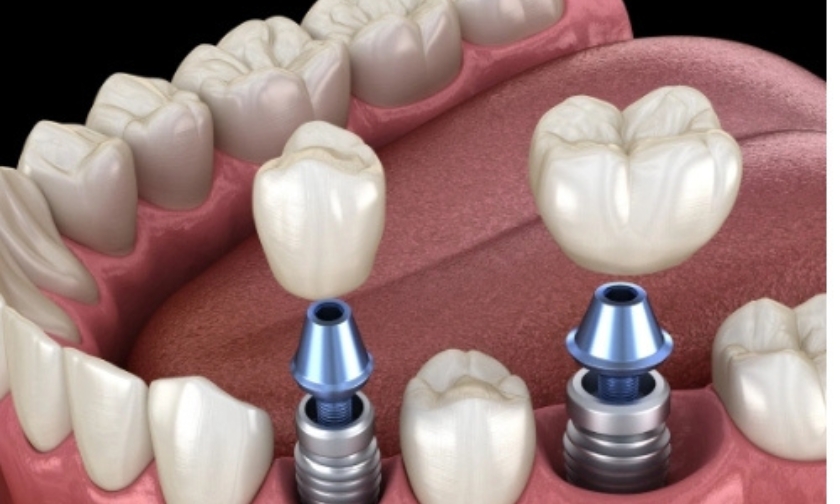 all-on-x implant recovery timeline
