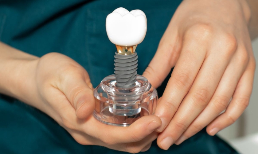 dental implants nederland