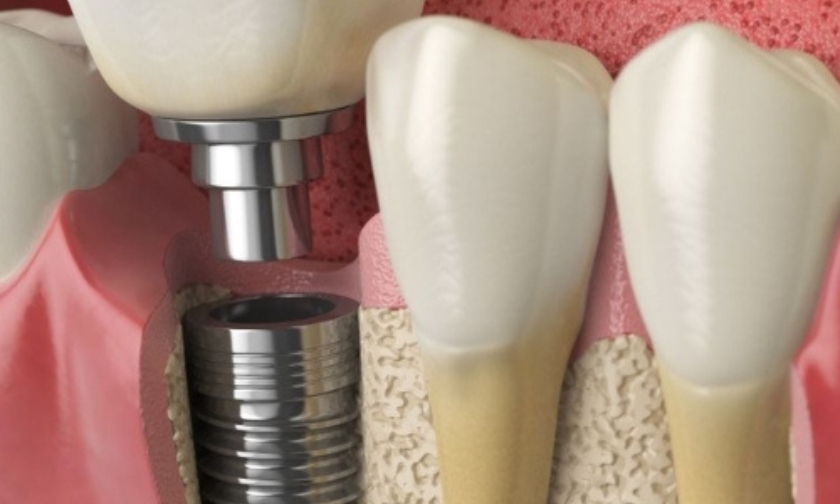 osseointegration impacts implant success