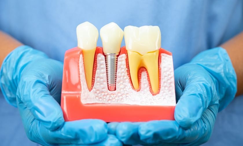 prf therapy speeds implant healing